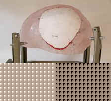 Cranioplastica new MAGAZINE