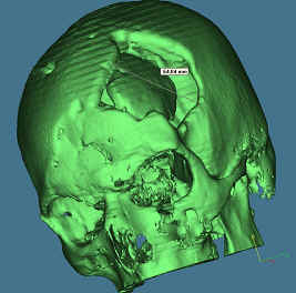Cranioplastica new MAGAZINE